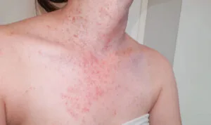 Manchas no pescoço: causas, tratamentos e prevenção