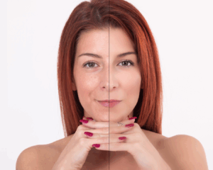 Tratamento com Fotona 4D para rejuvenescimento facial