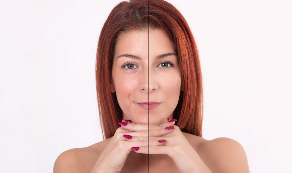 Tratamento com Fotona 4D para rejuvenescimento facial