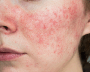 Tratamento para rosácea em Curitiba com tecnologias modernas na THA Dermatologia