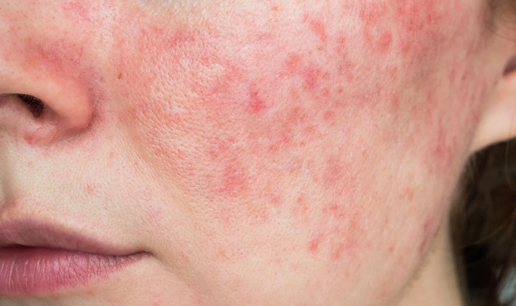 Tratamento para rosácea em Curitiba com tecnologias modernas na THA Dermatologia