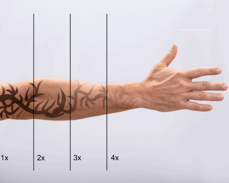 Remoção de tatuagem com laser em Curitiba na THA Dermatologia com Fotona Starwalker