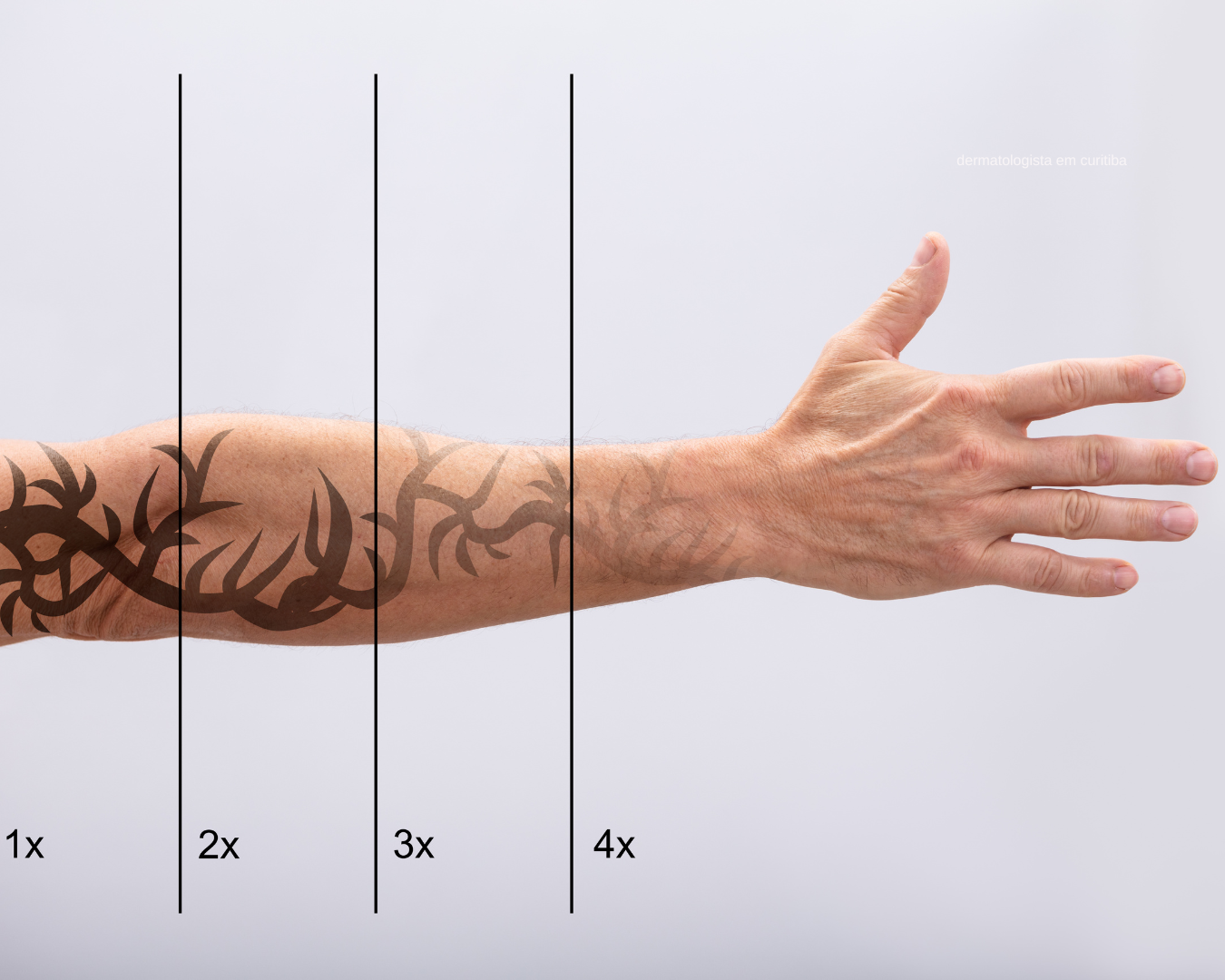 Remoção de tatuagem com laser em Curitiba na THA Dermatologia com Fotona Starwalker