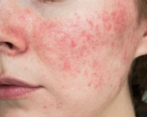 Tratamento para rosácea em Curitiba com tecnologias modernas na THA Dermatologia